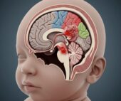 Brain Injury at Birth