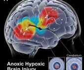 Anoxic Hypoxic Brain Injury