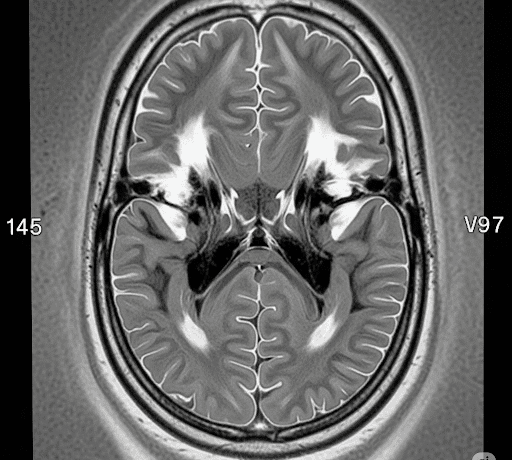 brain scan show cerebral palsy